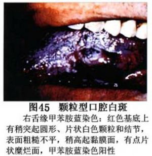 口腔白斑症 词条正文病损特点为,在发红的黏膜面上有细小颗粒样白色