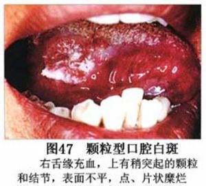 口腔白斑症