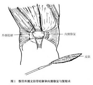 图1 髌骨外侧支持带松解和内侧修复与紧缩术