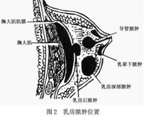 乳房膿腫位置