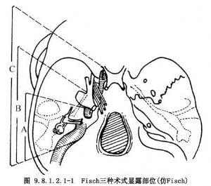 颞下窝入路手术