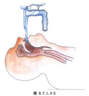 直接喉镜手术_手术_医学百科