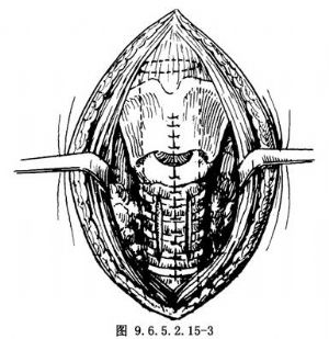 栅栏状喉气管切开置入t型管成形术_手术_医学百科