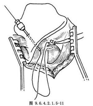 披裂软骨内收术_手术_医学百科