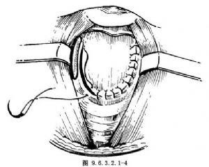 喉次全切除会厌瓣重建术_喉手术,手术,喉咽,喉及颈部食管癌的手术,喉