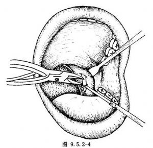 茎突过长症的手术