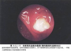 扁桃体的其他疾病,例如:扁桃体角化症,扁桃体结石,扁桃体息肉或囊肿
