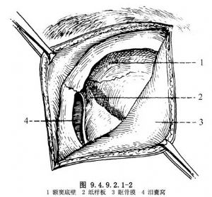 额窦底部及眼眶内侧壁的骨膜,分离泪囊及眶骨膜,暴露泪骨及筛骨纸样板