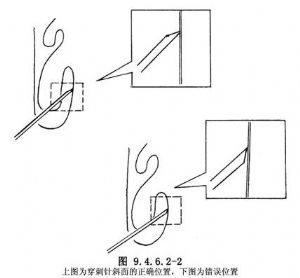 上颌窦穿刺术_手术,萎缩性鼻炎与慢性上颌窦炎的手术,医疗技术名,耳鼻