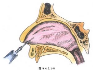 鼻中隔黏膜下切除术