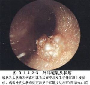 局限于耳廓及外耳道的癌肿,如基底细胞癌,腺样囊性癌及鳞状细胞癌等