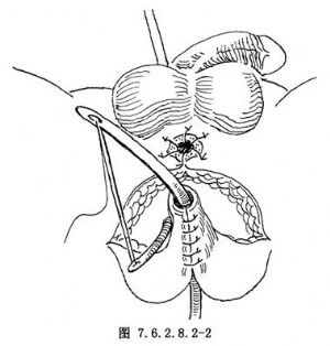 后尿道成形术_男性尿道手术,手术,尿道切开术及尿道成形术,尿道狭窄的