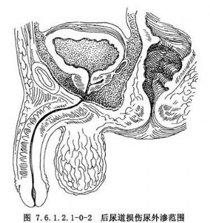 尿道会师牵引术