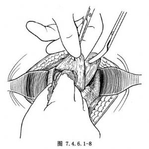 5放置引流及憩室口缝合游离膀胱侧壁至憩室口外,用一大弯血管钳经膀胱