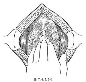 膀胱颈yv成形术