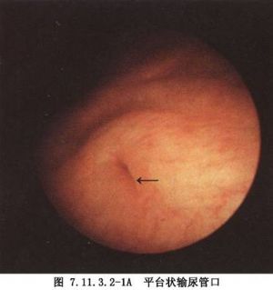 单纯的输尿管口囊肿位于膀胱三角区,在男性也可滑入尿道内,女性可突出