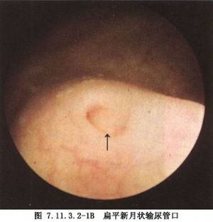 女性尿道口囊肿图片图片