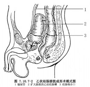 膀胱乙状结肠吻合术_手术_医学百科