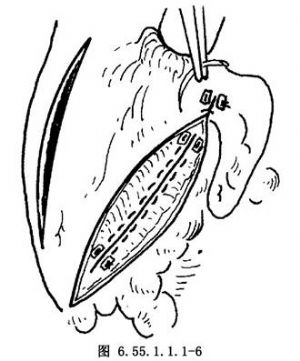 预激综合征kent束切断术_手术_医学百科