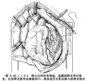 内乳动脉-冠状动脉旁路移植术