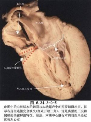 三尖瓣闭锁