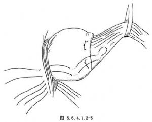 belsey4号胃底折叠术
