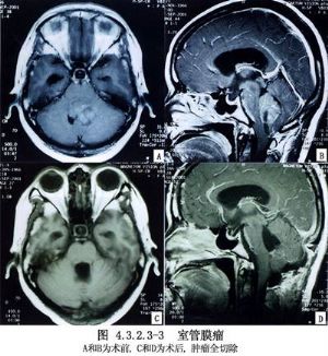 肿瘤手术/幕下肿瘤手术4分类第四脑室肿瘤切除术3手术名称resection