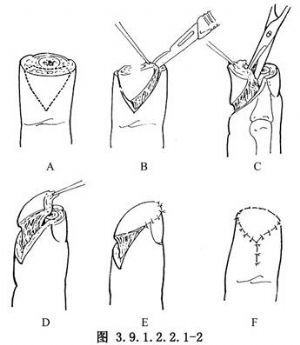 手部手术切口设计图片