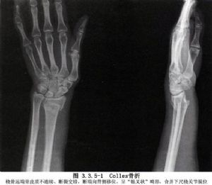 桡骨远端骨折为最常见的骨折之一,它包括科雷骨折(colle′s fracture)