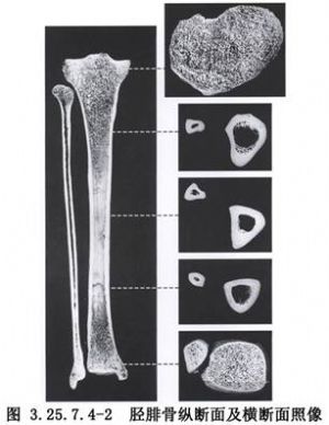 胫骨干骺端延伸术_手术_医学百科