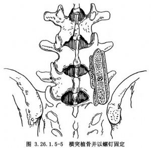 所显示的影像必须有充分估计,在剥离时不宜用力过猛以免造成横突骨折
