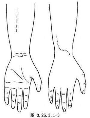 伸腕和伸指功能重建手术