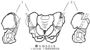 salter无名切骨术