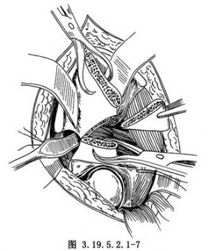 salter无名切骨术 词条正文用两把巾钳分别夹住截骨后的髂骨上,下两个