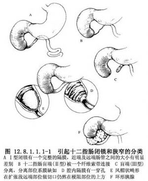 十二指肠十二指肠吻合术