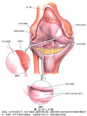 关节镜下膝关节滑膜病变切除术