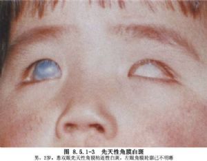 (2)角膜白斑(图8.5.1-3,8.5.1-4).