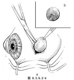 结膜囊肿摘除术_手术,结膜良性肿瘤切除的成形术,眼科手术,结膜手术