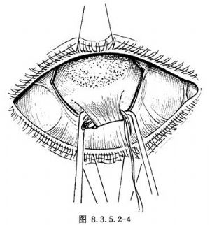 广泛睑球粘连穹隆再造术_手术,睑球粘连手术,眼科手术,结膜手术_医学