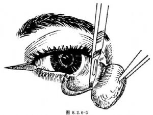 泪囊肿物摘除及眼睑成形术