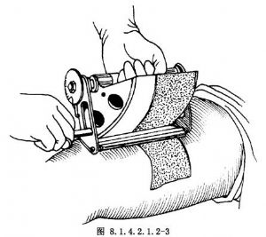 眼部断层皮片移植术_植皮术,游离皮肤移植,眼睑手术,手术,眼睑成形术