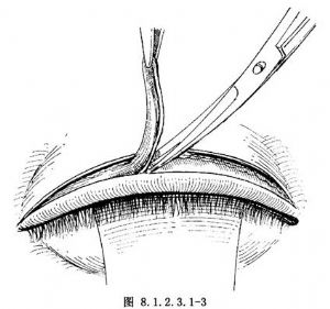 hotz法瘢痕性睑内翻矫正术