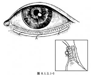 先天性睑内翻矫正术