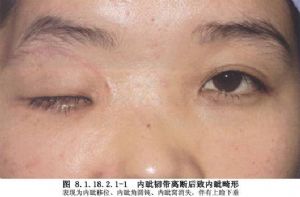 内眦韧带离断复位
