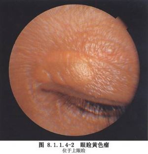 眼睑皮肤黄色瘤切除术