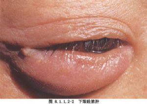 眼睑脓肿切开术_眼睑手术,手术,眼睑小手术,眼科手术_医学百科