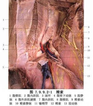 经腹膜后精索内静脉结扎术