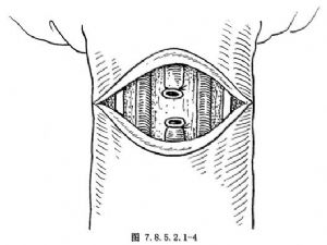 3.缝合切口将切开的buck筋膜用细丝线间断缝合,防止阴茎体与皮肤粘连.