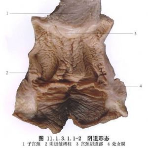 阴道裂伤缝合术