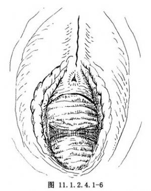 女性阴部切割术